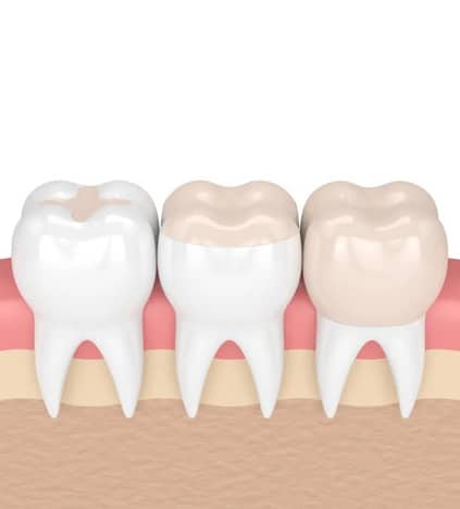 Three teeth illustration showing natural color variations in gum line dental setting