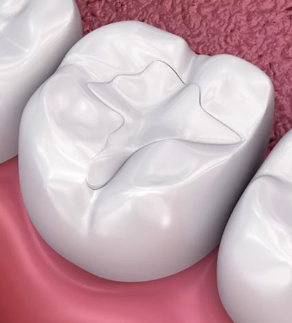 White dental crown model displayed on pink background showing tooth restoration design.