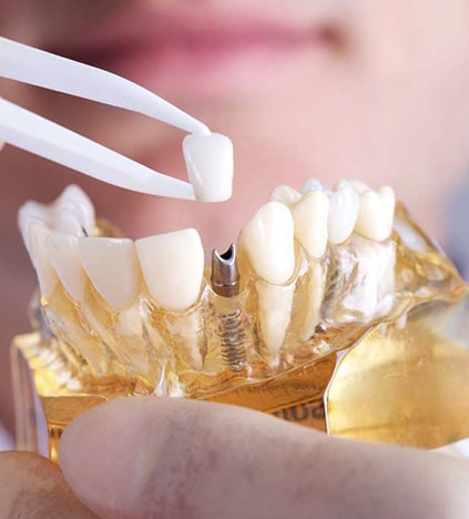 Dental implant model with tweezers showing tooth replacement procedure in clinical setting