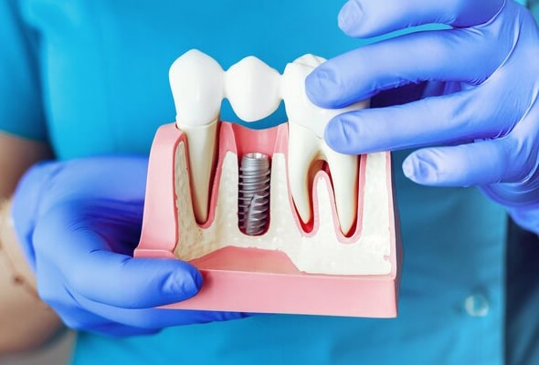 Dentist in blue gloves holding dental implant model showing tooth replacement procedure.