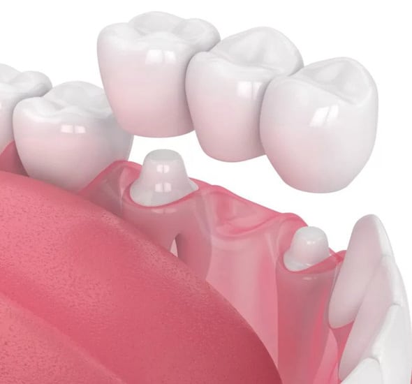 Dental crowns displayed above gum model showing tooth replacement restoration procedure.