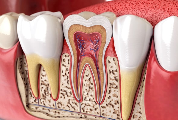 Cross-section diagram of tooth anatomy showing internal structures and decay within the pulp chamber.