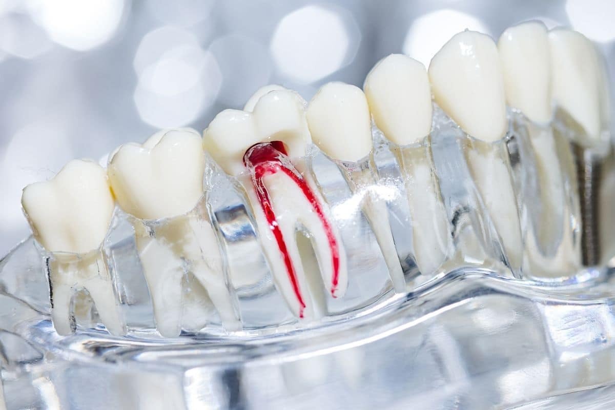 Tooth model showing root canal anatomy with red pulp tissue inside clear cross-section.