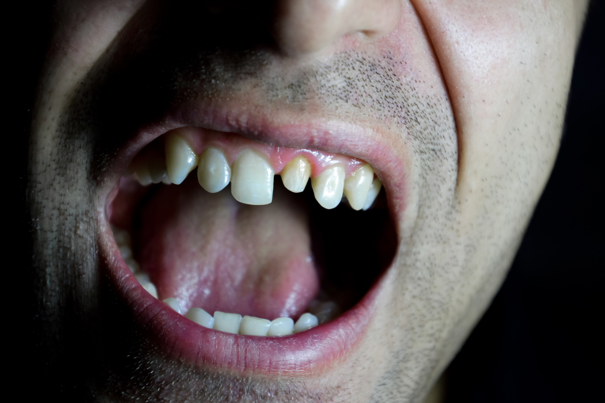 A Tooth That Keeps Breaking in the Same Spot_ What Can Be Done