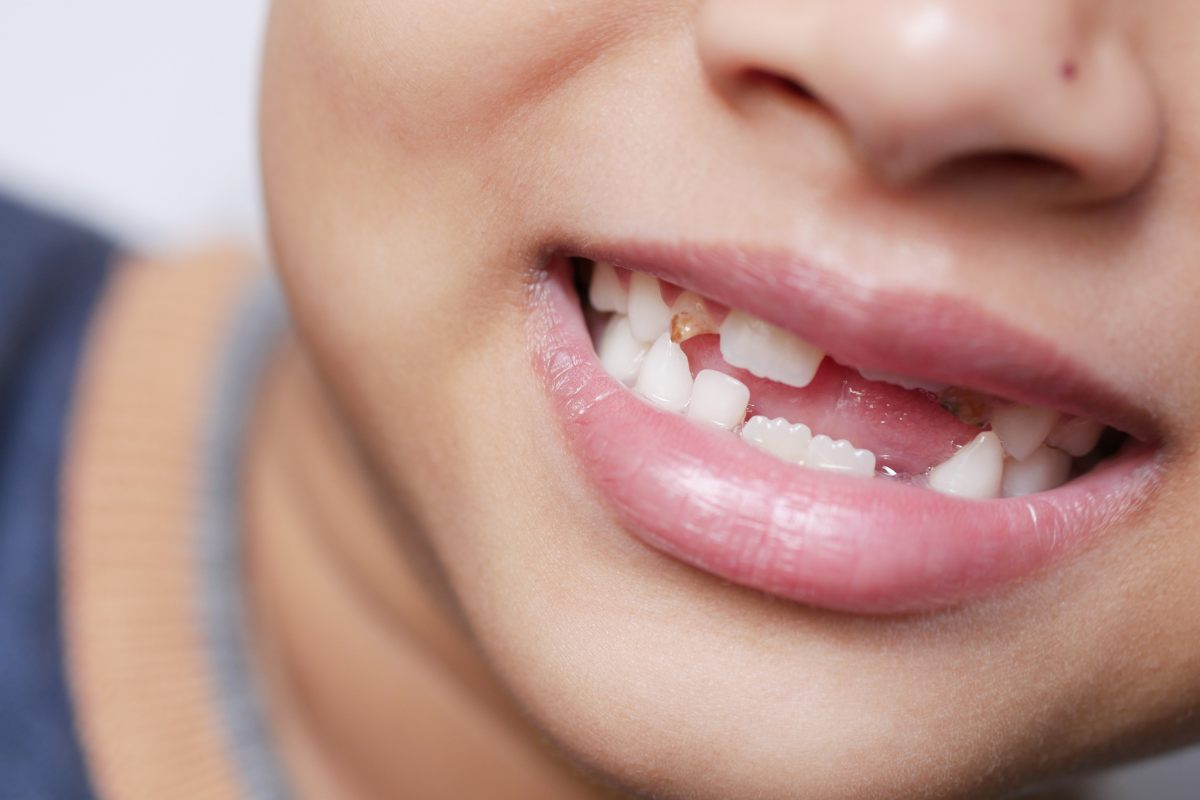 Replacing Several Missing Teeth: Your Options Beyond Implants